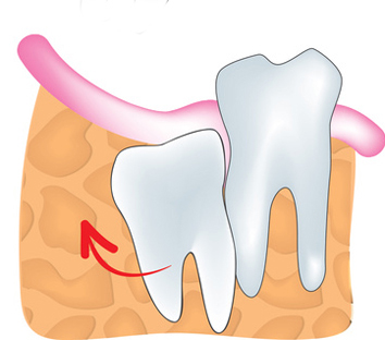 口腔外科、親知らずの抜歯 | 医療法人社団E.Y.Dent すが歯科クリニック 